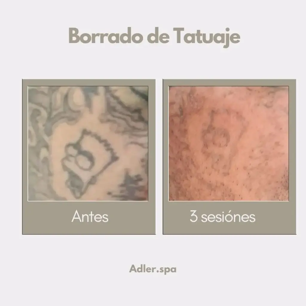 Borrado de Tatuajes