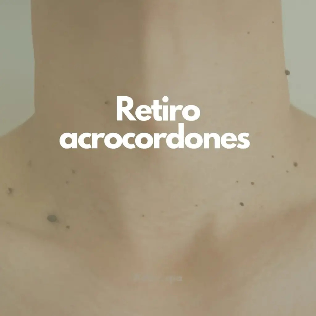 Retiro de Acrocordones