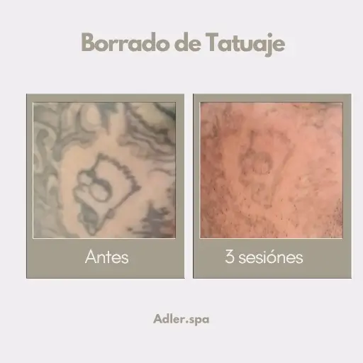 Borrado de Tatuajes